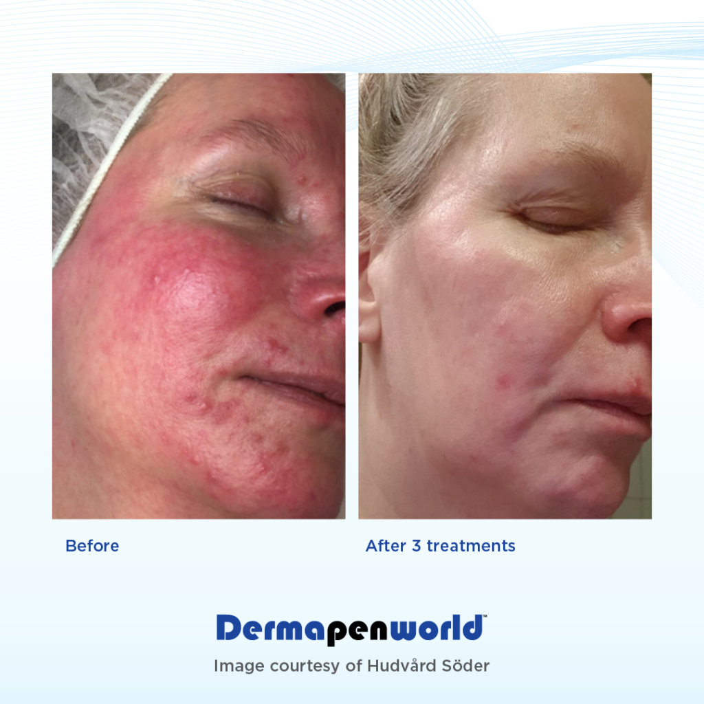 Dermapen-Before-and-After-Rosacea