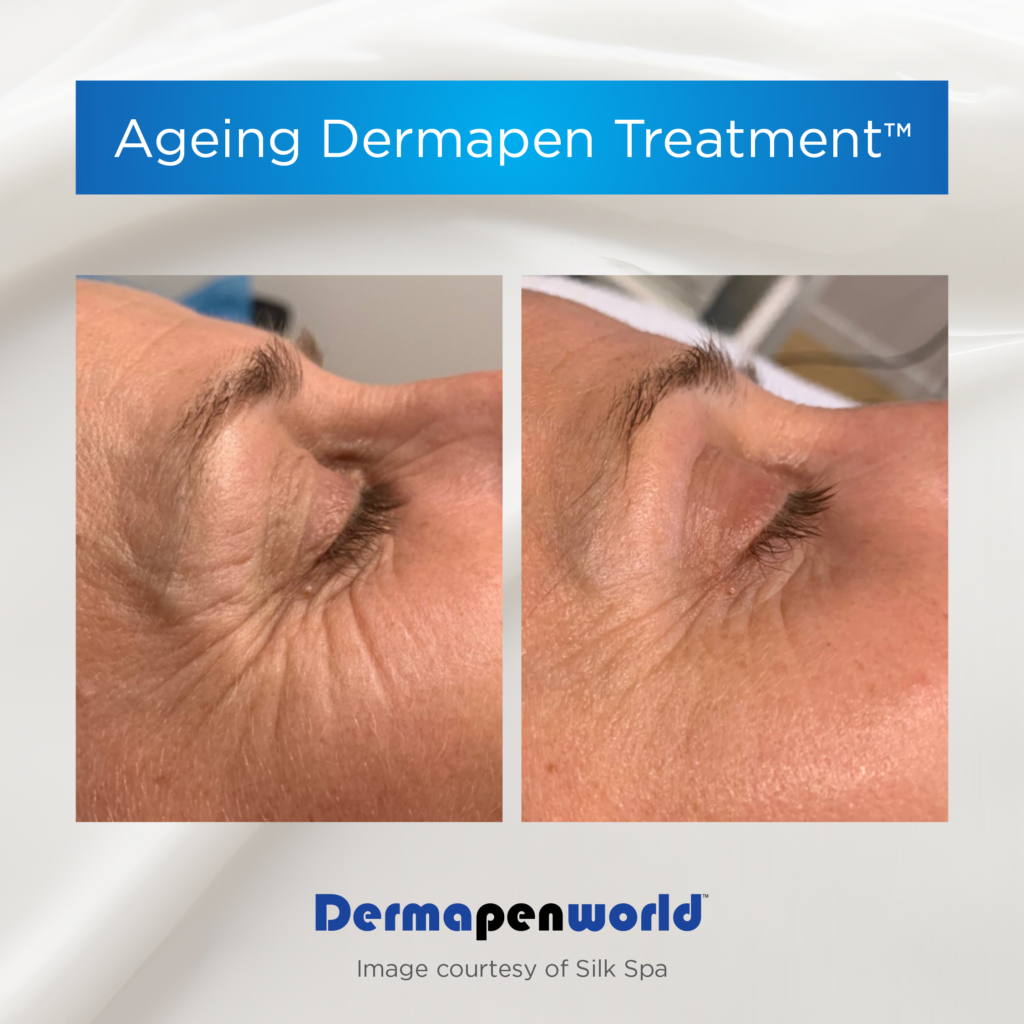 Dermapen-Wrinkles-Before-and-After