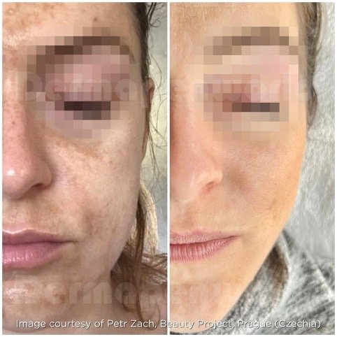 MG BL & Uber pro Peel - B&A - Courtesy Beauty Project - Prague - Czech Republic