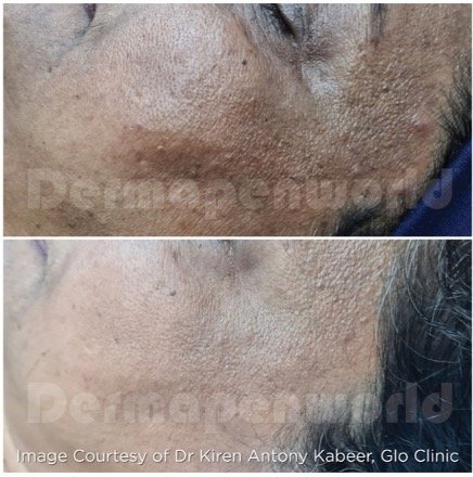 MG BL & Uber pro Peel - B&A - Courtesy Glo Clinic - Chnnai - India