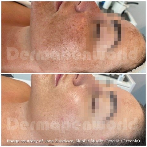 MG BL & Uber pro Peel - B&A - Courtesy SkinFit Studio - Prague - Czech Republic