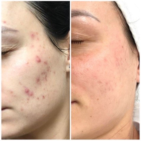 MG CLR & MG BL & Uber Pro Peel - B&A - Courtesy Beauty Project - Prague - Czech Republic