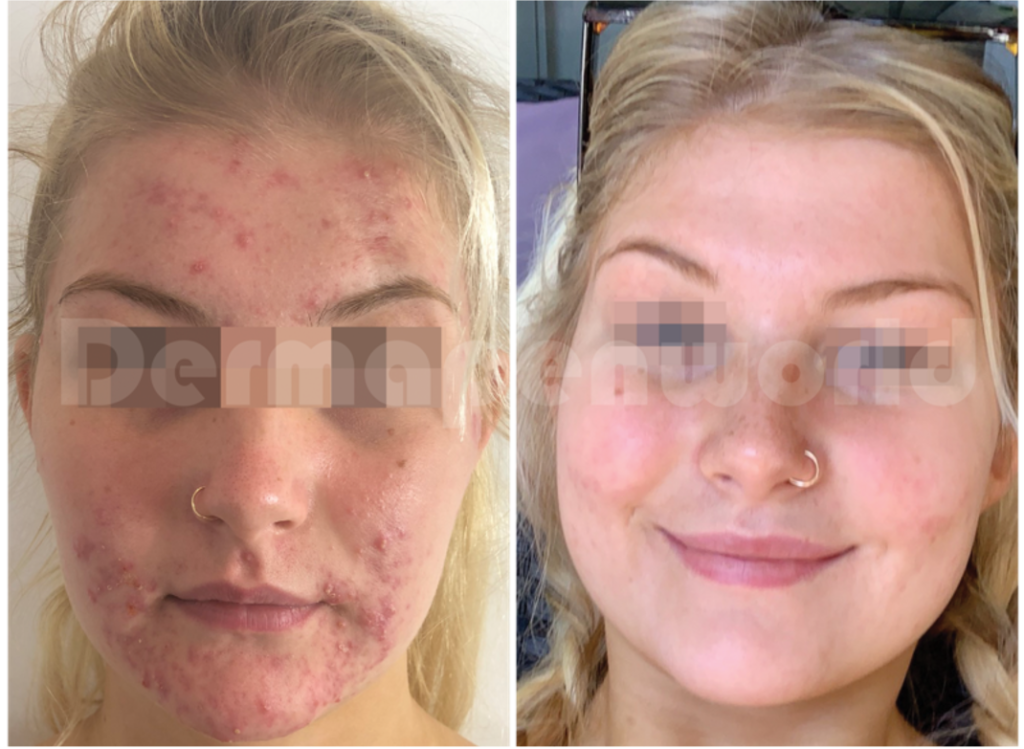 MG CLR & Uber Pro Peel - B&A - Dermapenworld